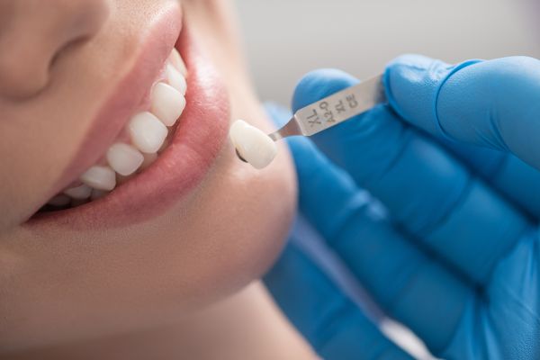 Dental Veneers Require Specific Aftercare Instructions